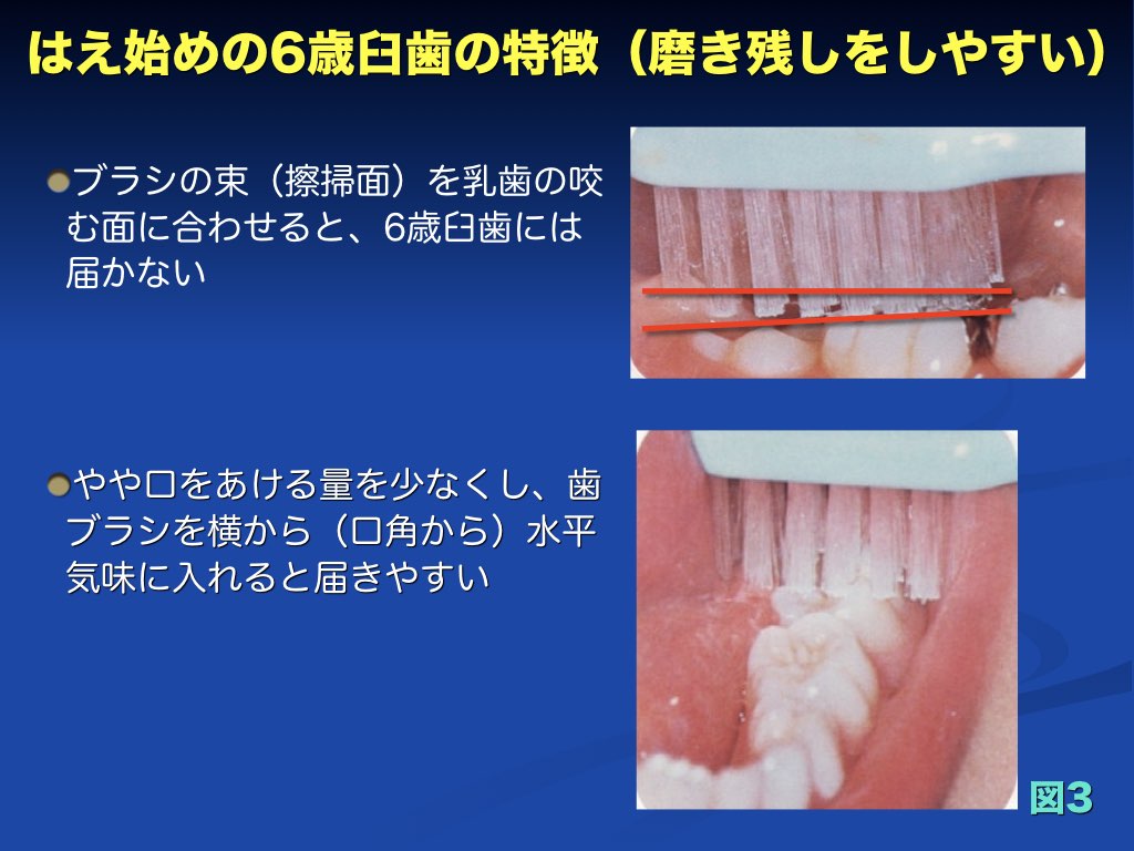 35％OFF オカムラ はみがき先生 ６歳臼歯が磨きやすい 奥歯の永久歯がはえてきたら １本 歯ブラシ 子供 broadcastrf.com