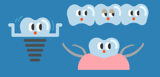 歯の抜けた顎の治療オプション