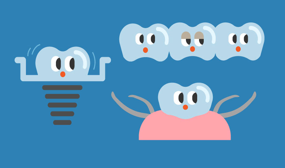 歯の抜けた顎の治療オプション