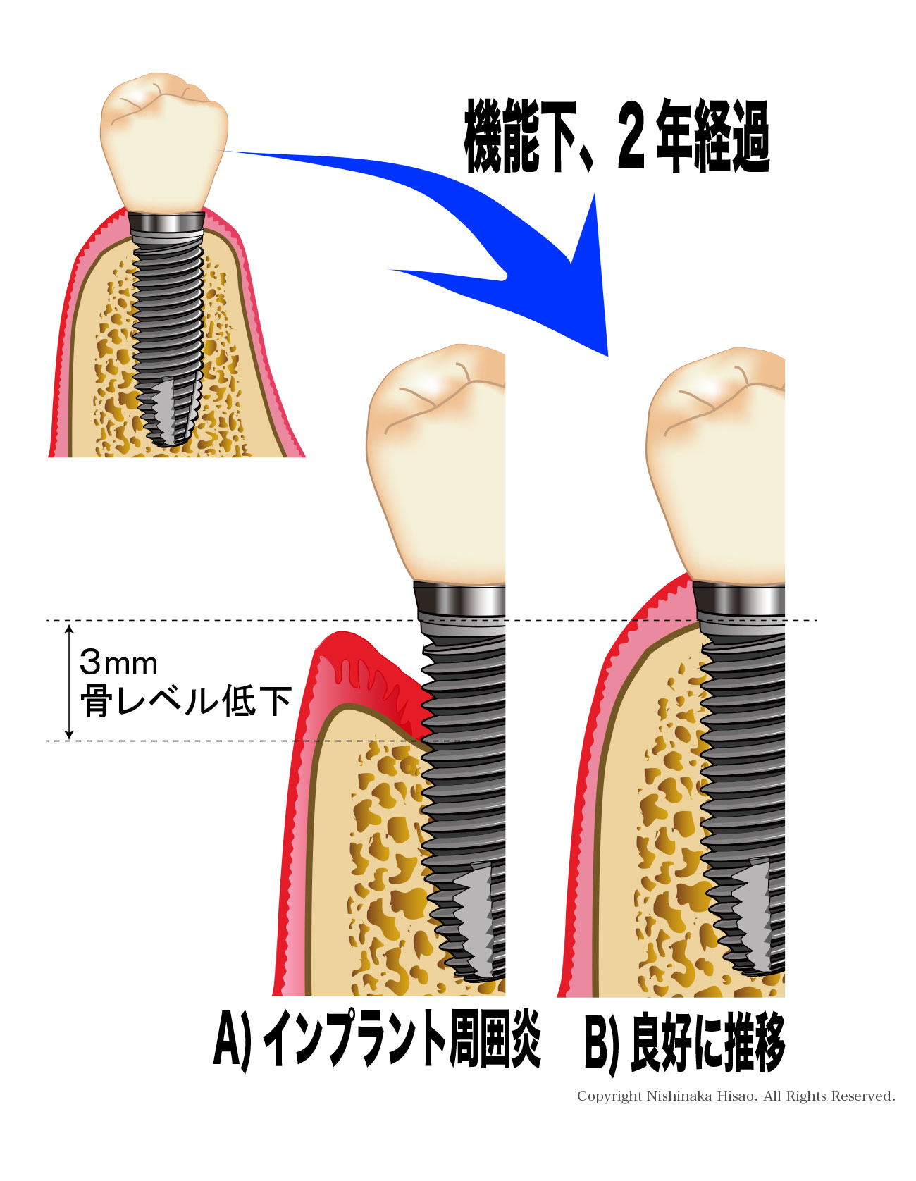 インプラントの寿命は？ｰ生存率と成功率ｰ | にしなか歯科クリニック