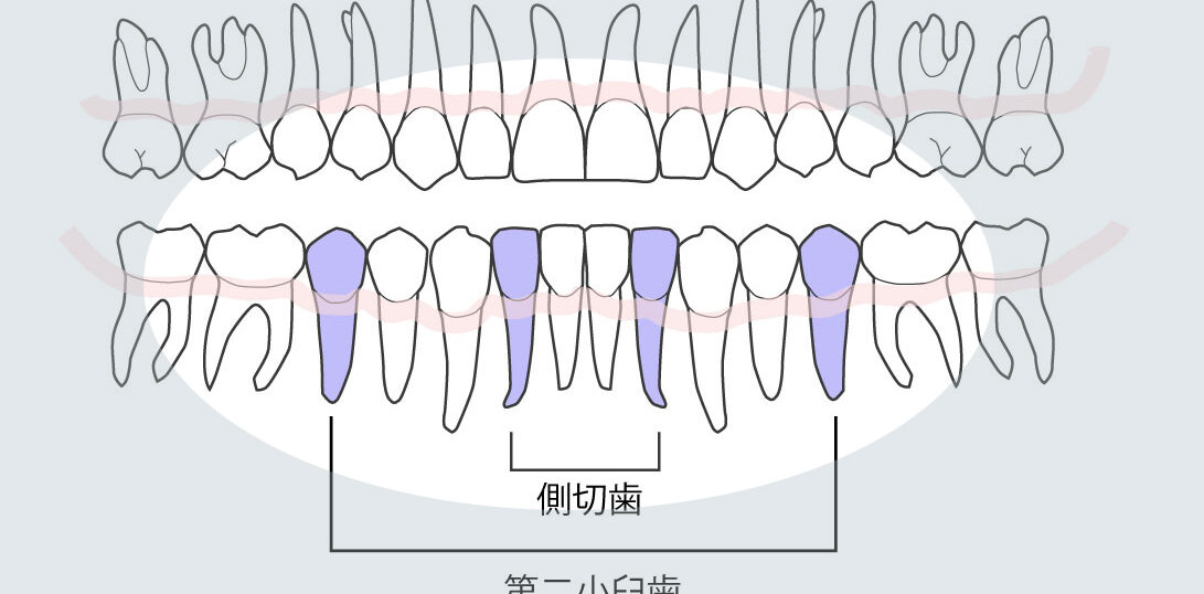 永久歯先天性欠如好発部位