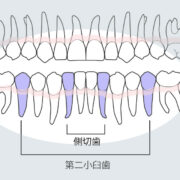 永久歯先天性欠如好発部位