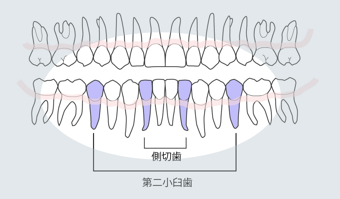 歯の欠損　ー永久歯の先天性欠如ー