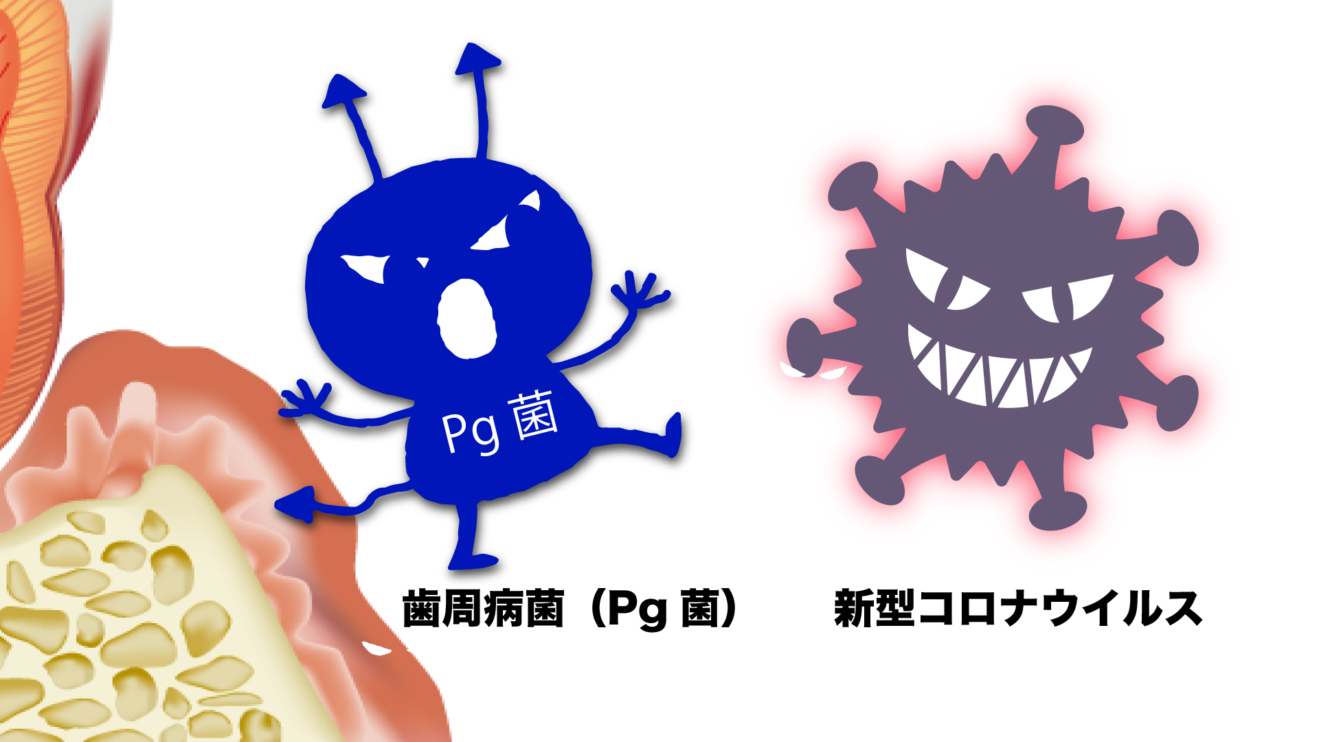 歯周病菌は新型コロナウイルス感染の手助けをする