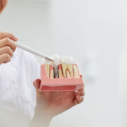 インプラント治療流れアイキャッチ画像