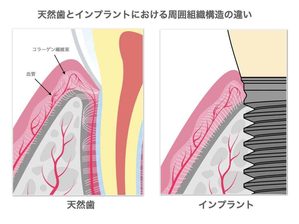 歯とインプラントとの違いー血管痾ー