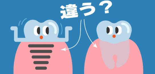インプラントと天然歯の違いトップ画像