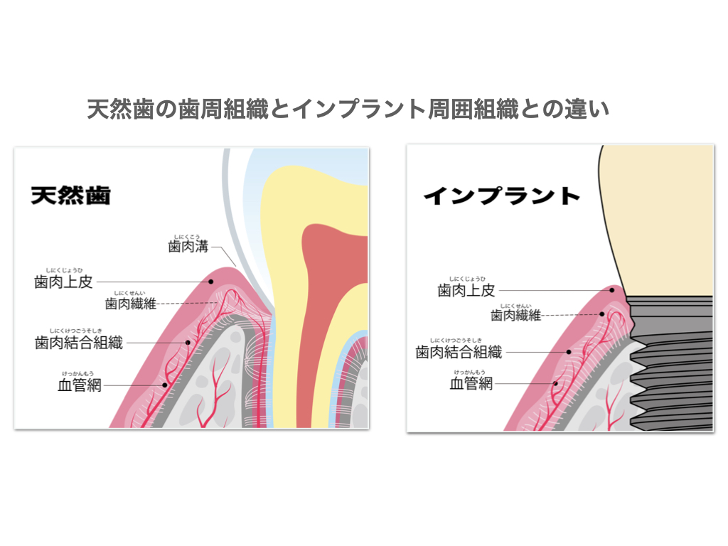 歯周組織とインプラント周囲組織